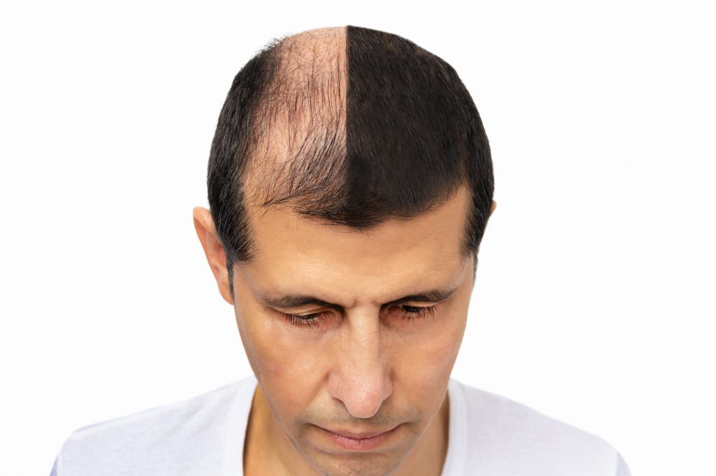 Top of a man’s head, thinning on one side and full on the other, before and after