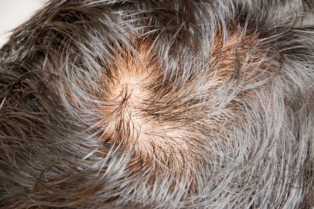 Crown of a head with thinning grey-brown hair